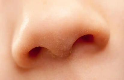 干货速看，鼻部口周烧伤应如何处理？